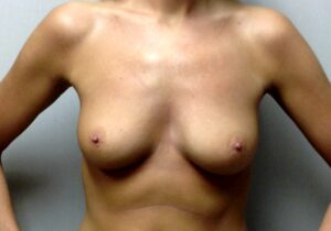 Breast Augmentation at Birmingham Cosmetic Surgery