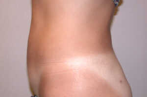 body-lipo-03L-after